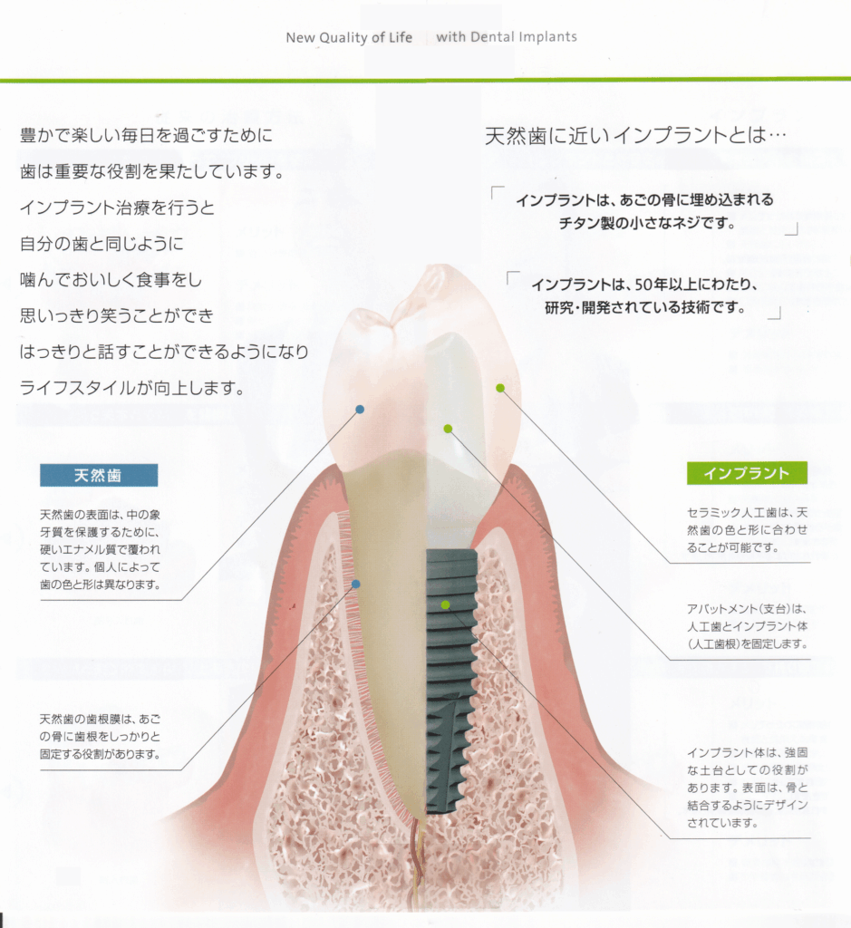 インプラント骨結合